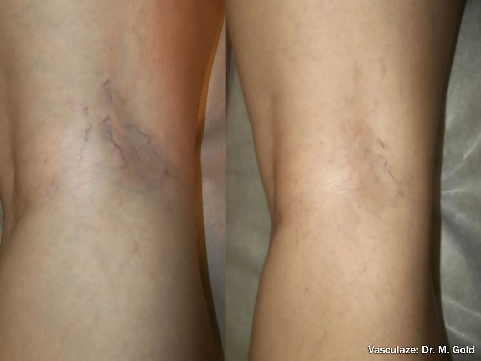 Before and After Photos